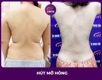 Hút mỡ 2 bên hông: Giải pháp “siết eo” giúp dáng thon gọn nhanh chóng